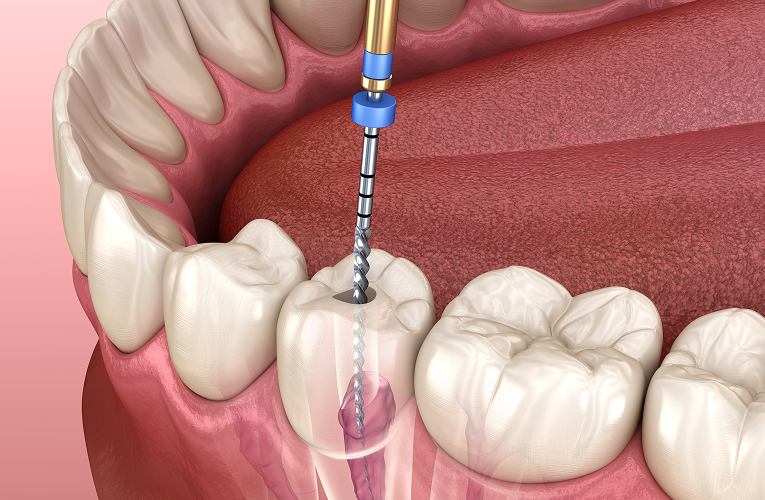 Pediatric Root Canal Treatment for children in Norwalk CA