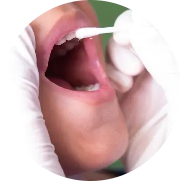 Fluoride Treatment