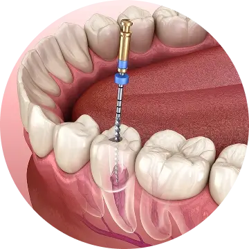 Root Canal Treatment